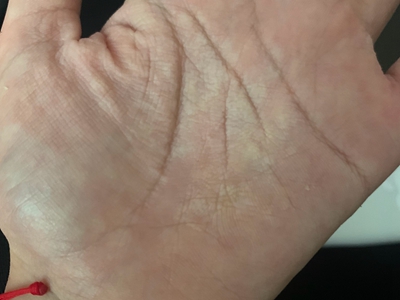 窩狀角質松解症手心皮膚增厚顏色發白圖 窩狀角質松解症手心皮膚增厚顏色發白圖