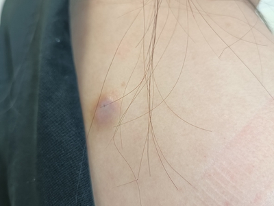 皮脂腺囊腫背部出現圓形的扁平疙瘩圖 皮脂腺囊腫背部出現圓形的扁平疙瘩圖