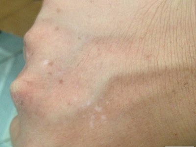 特發性滴狀色素減少症手背有幾個白斑圖 特發性滴狀色素減少症手背有幾個白斑圖