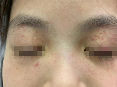 血管內壓力增多性紫癜眼周全是小紅點圖 血管內壓力增多性紫癜眼周全是小紅點圖
