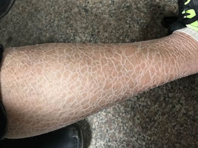 先天性胚葉發育不良小腿有褐色斑片圖 先天性胚葉發育不良小腿有褐色斑片圖