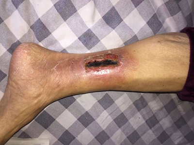 糖尿病性皮膚病小腿傷口發黑周圍紅腫圖 糖尿病性皮膚病小腿傷口發黑周圍紅腫圖
