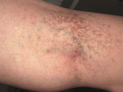 遺傳性對稱性色素異常症膕窩有網狀斑圖