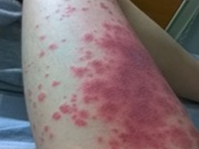 丘疹型輕型多形紅斑大腿上大片紅斑圖