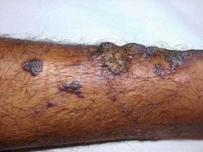 丘疹型血管角皮瘤小腿上丘疹結厚痂圖 丘疹型血管角皮瘤小腿上丘疹結厚痂圖