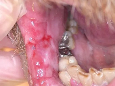 頜面部獲得性梅毒口腔黏膜有很多白斑圖 頜面部獲得性梅毒口腔黏膜有很多白斑圖
