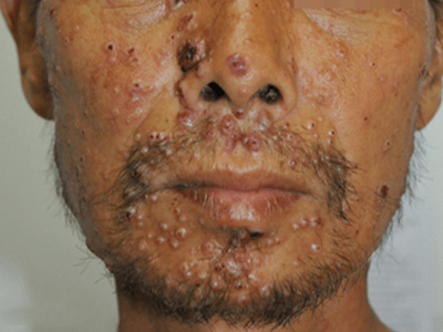 單純皮膚型原藻病臉上長了很多疙瘩圖 單純皮膚型原藻病臉上長了很多疙瘩圖