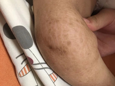 先天性外胚葉發育不良小腿黑褐色斑片圖