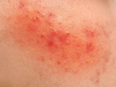 糖皮質激素依賴性皮炎面部有紅斑丘疹圖 糖皮質激素依賴性皮炎面部有紅斑丘疹圖