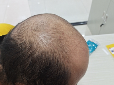 雄激素性脫髮頭頂及前額頭髮大量脫落圖 雄激素性脫髮頭頂及前額頭髮大量脫落圖