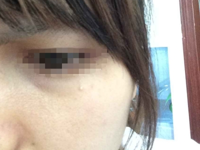 孤立性毛髮上皮瘤左眼下有一小疙瘩圖 孤立性毛髮上皮瘤左眼下有一小疙瘩圖
