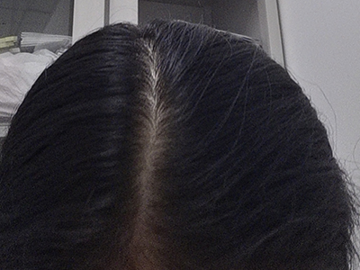 雄激素性脫髮頭頂頭髮脫落髮縫變寬圖 雄激素性脫髮頭頂頭髮脫落髮縫變寬圖