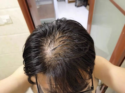 雄激素性脫髮頭頂快禿了有少量頭髮圖 雄激素性脫髮頭頂快禿了有少量頭髮圖