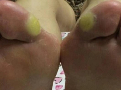 胼胝兩個大腳趾外側面長出大黃硬疙瘩圖 胼胝兩個大腳趾外側面長出大黃硬疙瘩圖