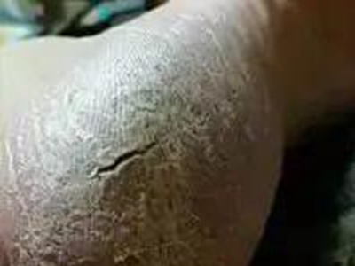 手足皸裂腳後跟出現增厚黃皮還有裂口圖