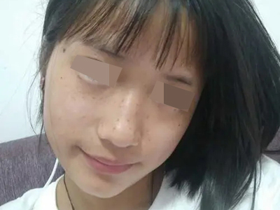 雀斑鼻樑和臉頰上長了幾個黃褐色斑點圖