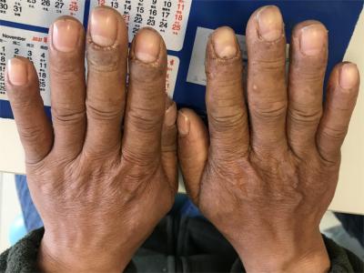 手部濕疹手背和手指表面發黑皮膚粗糙圖 手部濕疹手背和手指表面發黑皮膚粗糙圖