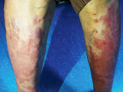 尋常型銀屑病雙側小腿有大面積紅斑圖 尋常型銀屑病雙側小腿有大面積紅斑圖