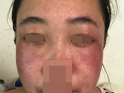 糖皮質激素依賴性皮炎臉上大面積紅斑圖