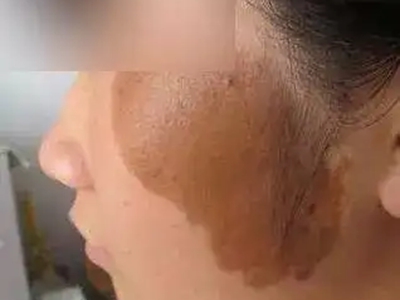 咖啡斑左臉頰上有大片深咖色不規則斑圖