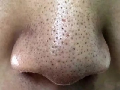 黑頭鼻子上有很多密密麻麻的小黑點圖