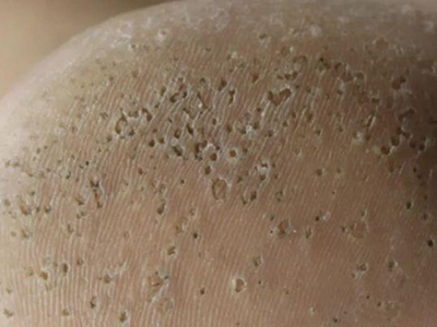 溝狀跖部角質松解症腳後跟有小坑發黑圖