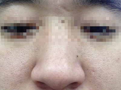黑頭臉上有很多小黑點樣的黑頭粉刺圖