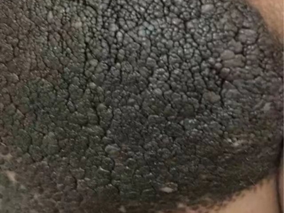 獸皮痣腹部皮膚上一大片黑痣有裂紋圖 獸皮痣腹部皮膚上一大片黑痣有裂紋圖