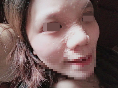 多發性毛髮上皮瘤臉上好多肉色疙瘩圖 多發性毛髮上皮瘤臉上好多肉色疙瘩圖