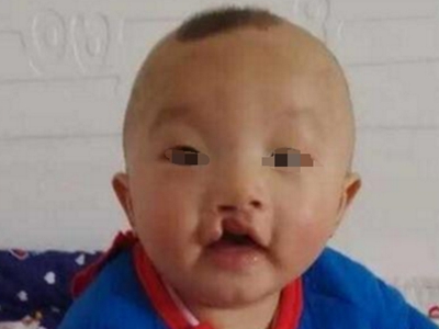 先天性外胚葉發育不良嘴唇上有缺損圖 先天性外胚葉發育不良嘴唇上有缺損圖