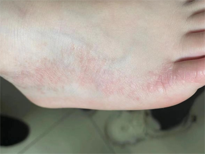 線狀苔蘚腳背部線狀分布紅色小丘疹圖 線狀苔蘚腳背部線狀分布紅色小丘疹圖