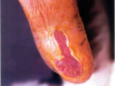 糖尿病性皮膚病腳底大片黃斑還爛了圖