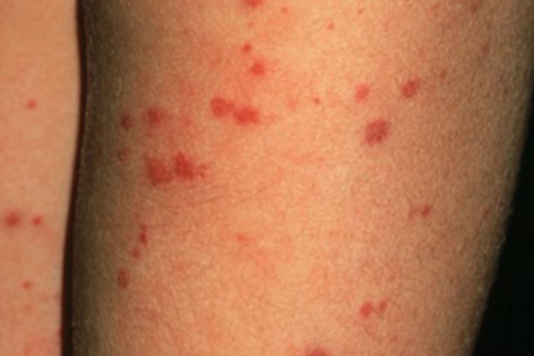 小兒過敏性紫癜大腿散布紅色斑丘疹圖 小兒過敏性紫癜大腿散布紅色斑丘疹圖