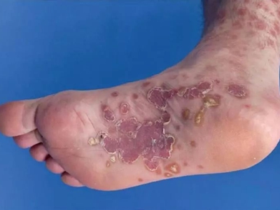 斑疹性梅毒疹腳底長紫色斑塊有脫屑圖 斑疹性梅毒疹腳底長紫色斑塊有脫屑圖