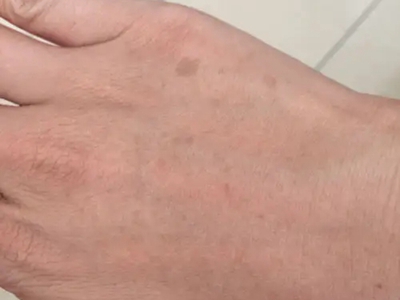網狀肢端色素沉著手背上長褐色斑塊圖 網狀肢端色素沉著手背上長褐色斑塊圖