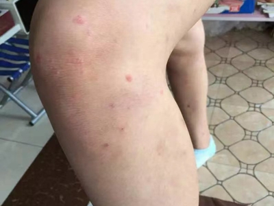 尋常型銀屑病膝蓋附近長几個小紅疙瘩圖