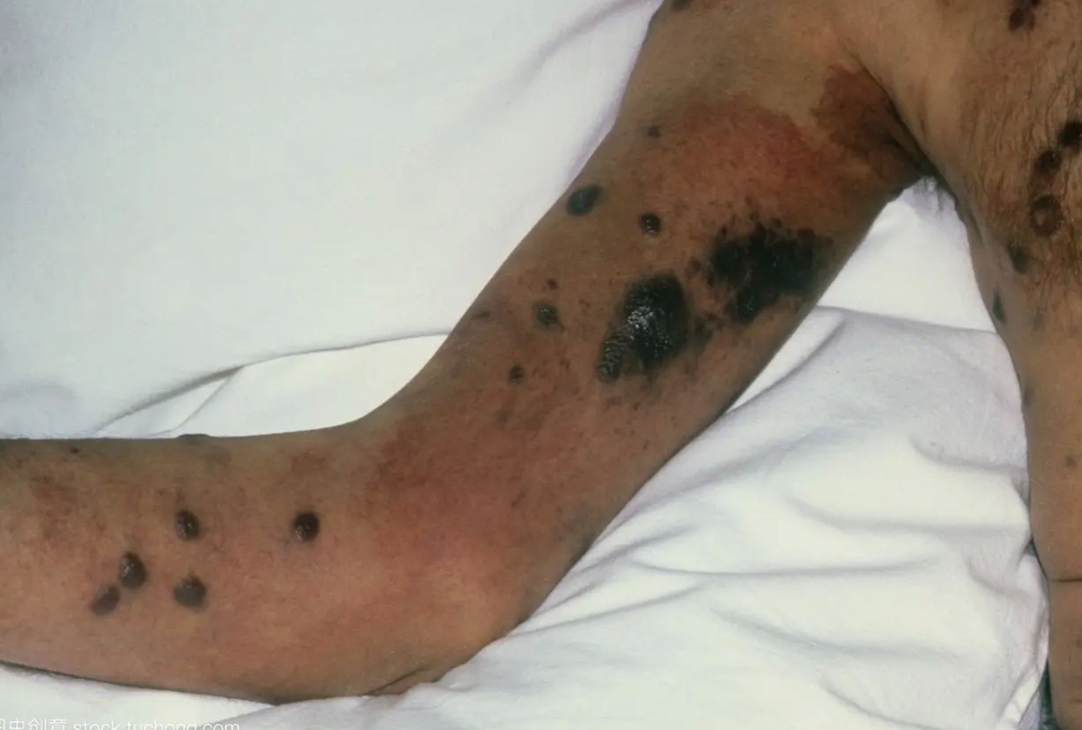 愛滋病皮膚腫瘤胳膊上長棕黑色斑塊圖