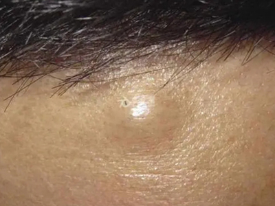 孤立性毛髮上皮瘤前額鼓起一個硬包圖 孤立性毛髮上皮瘤前額鼓起一個硬包圖