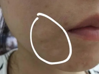 硬化性汗腺導管癌臉上有一塊皮膚發白圖 硬化性汗腺導管癌臉上有一塊皮膚發白圖