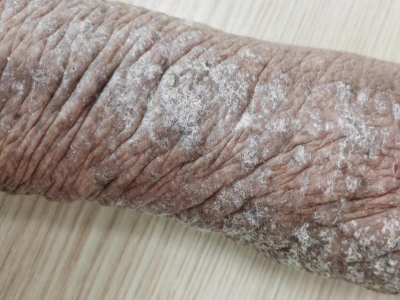 播散性神經性皮炎手臂上有大面積苔蘚圖 播散性神經性皮炎手臂上有大面積苔蘚圖