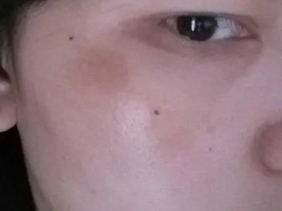 硬化性汗腺導管癌臉上有一塊黃色結節圖 硬化性汗腺導管癌臉上有一塊黃色結節圖