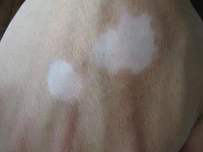 特發性滴狀色素減少症手背兩塊白斑圖 特發性滴狀色素減少症手背兩塊白斑圖