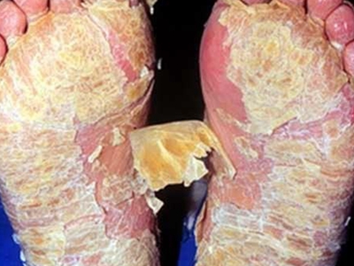 局限性膿皰型銀屑病腳底布滿黃色厚痂圖 局限性膿皰型銀屑病腳底布滿黃色厚痂圖