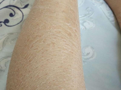 先天性外胚葉發育不良小腿有淺褐色斑圖 先天性外胚葉發育不良小腿有淺褐色斑圖