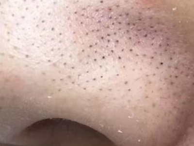小棘毛壅病鼻翼密密麻麻的黑色丘疹圖 小棘毛壅病鼻翼密密麻麻的黑色丘疹圖