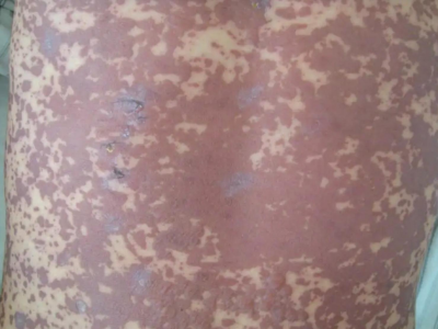 重型多形紅斑背上長滿了暗紅斑還糜爛圖