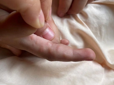 手部濕疹右手食指內側有凸起的小疙瘩圖 手部濕疹右手食指內側有凸起的小疙瘩圖
