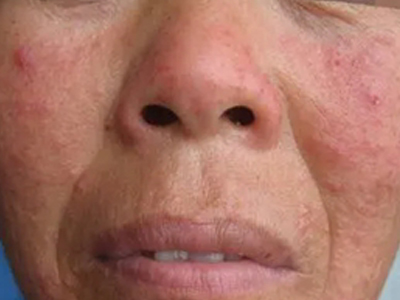 糖皮質激素依賴性皮炎面部長小紅疙瘩圖 糖皮質激素依賴性皮炎面部長小紅疙瘩圖