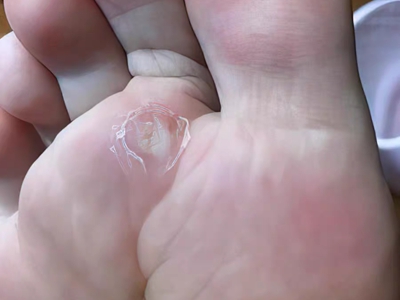 胼胝第二腳趾下面有個脫皮發白的硬塊圖