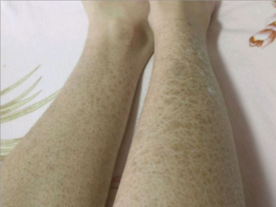 先天性胚葉發育不良小腿有黑褐色斑片圖 先天性胚葉發育不良小腿有黑褐色斑片圖